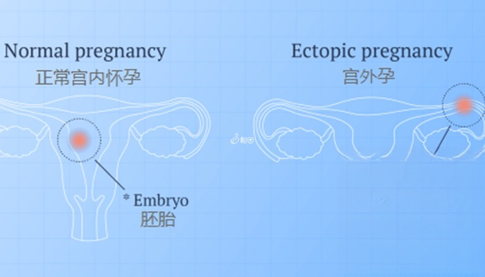 宫外孕比正常怀孕对比