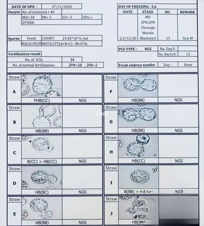 23对筛查通过7个胚胎