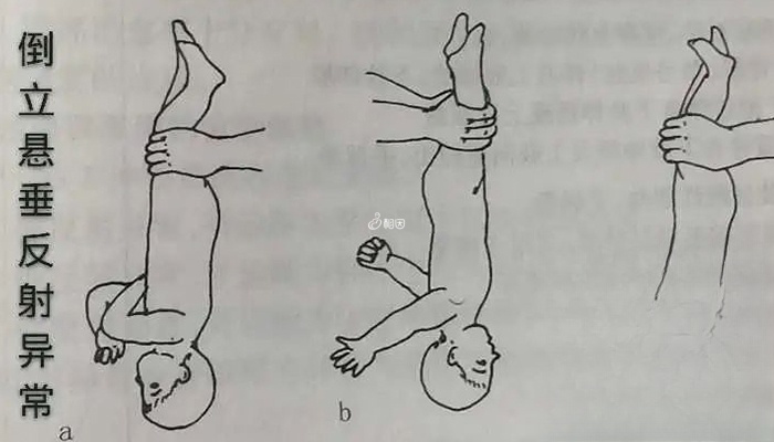 倒位悬垂反射异常表现