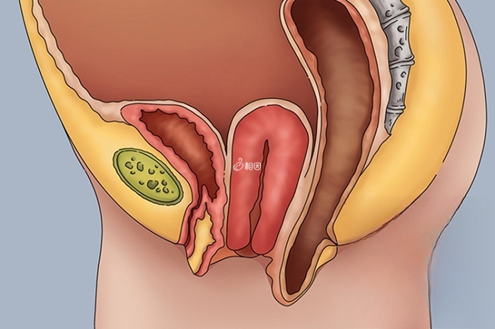 1度子宫脱垂图片
