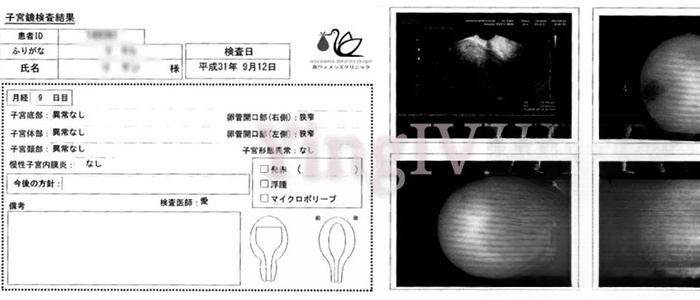 宫腔镜检查结果