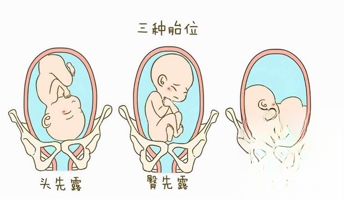 胎位不同的宝宝为了顺利生产需要进行内旋转