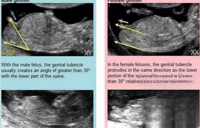 NT检查主要通过胎儿尾椎处的倾斜角度判断男女