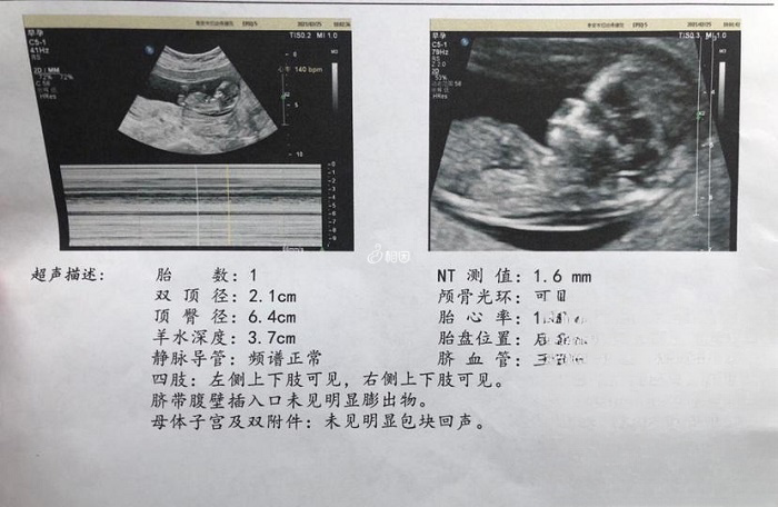 nt值大于1.5是怀男孩的明显特征