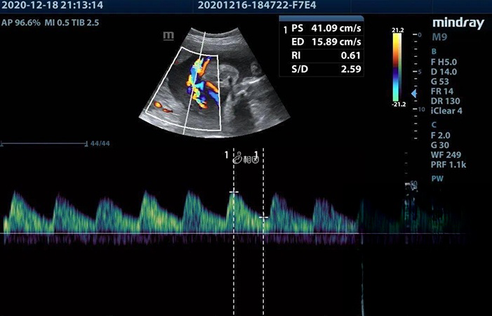 脐动脉血流s/d值就是收缩期与舒张期的比值