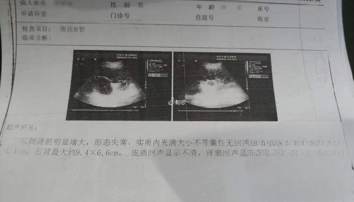 多囊肾检查结果