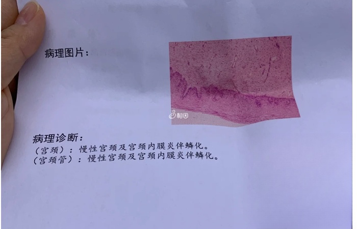 非典型鳞状细胞可能是宫颈炎症或癌前病变