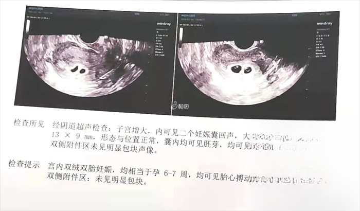 第二次胚胎移植成功怀上双胞胎