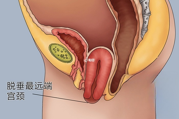 Ⅱ度子宫脱垂宫颈已脱出阴道口外