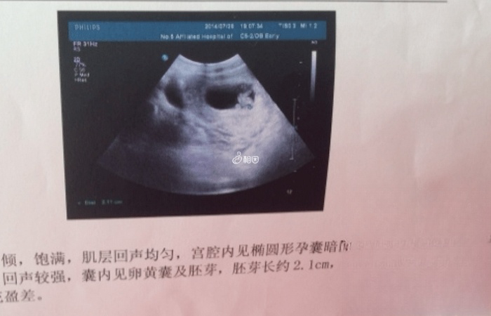 B超监测下的孕囊大小也可以计算孕周