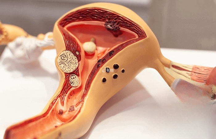 通过日常运动在一定程度上缓解腺肌症