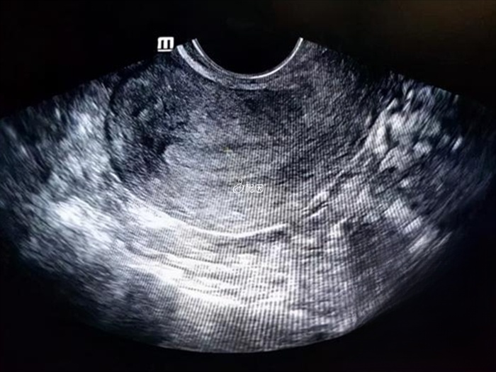 子宫内膜厚度有周期性