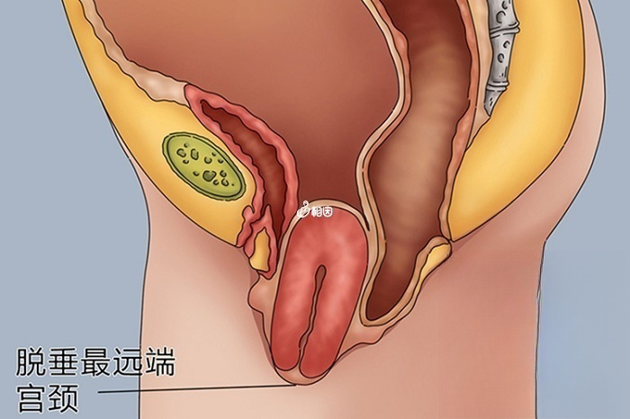 Ⅱ度重度脱垂宫颈及部分宫体脱出阴道口