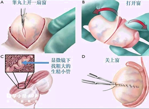 显微取精操作步骤图