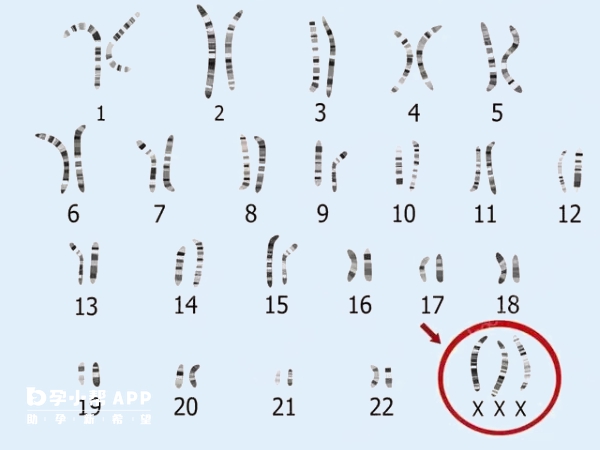 染色体疾病可选择三代试管助孕