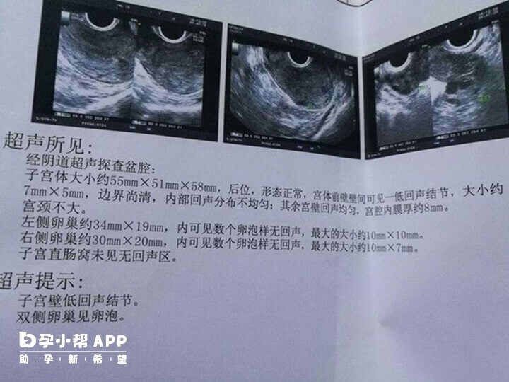 卵泡监测报告单