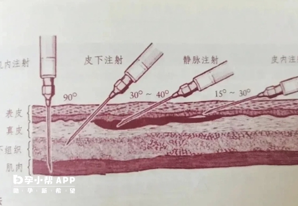 打黄体酮需要进行热敷