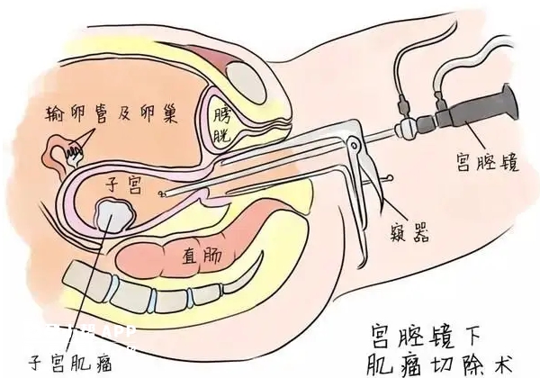 做宫腔镜不会导致宫腔粘连