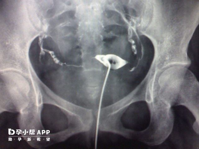 输卵管堵塞三种类型详解，不同程度检查及治疗方法均不同 - 诺娃