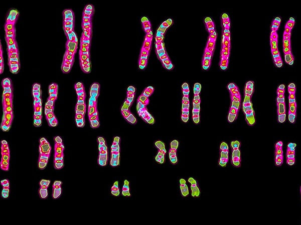 染色体异常会遗传疾病
