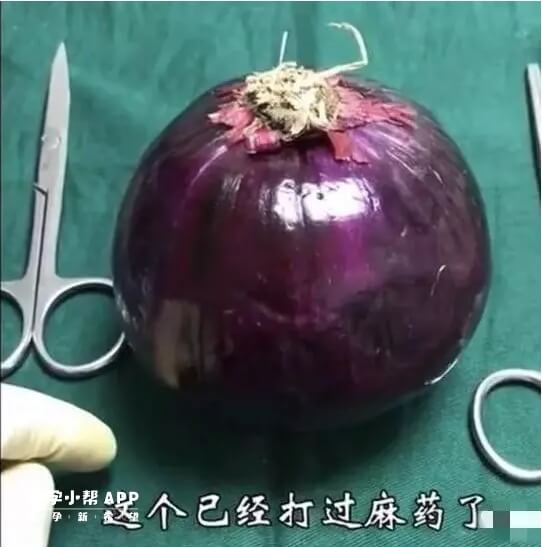 洋葱模仿剖腹产手术