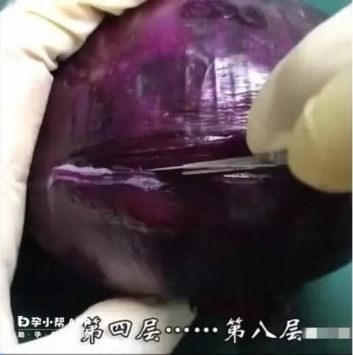 洋葱模仿剖腹产第二步