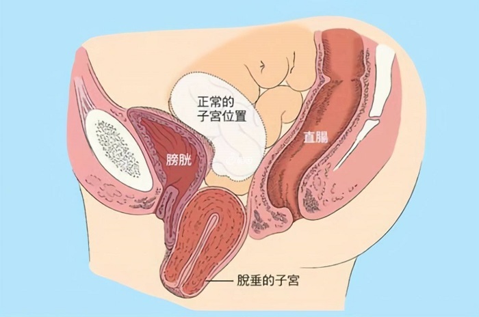 Ⅲ度子宫脱垂图