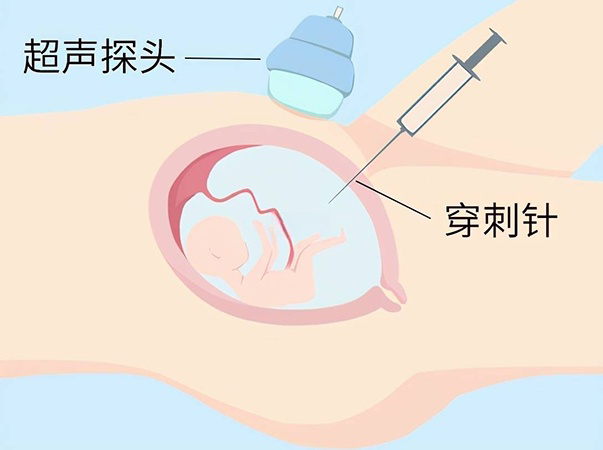 羊水穿刺即羊膜腔穿刺术检查