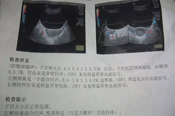 巧克力囊肿症状