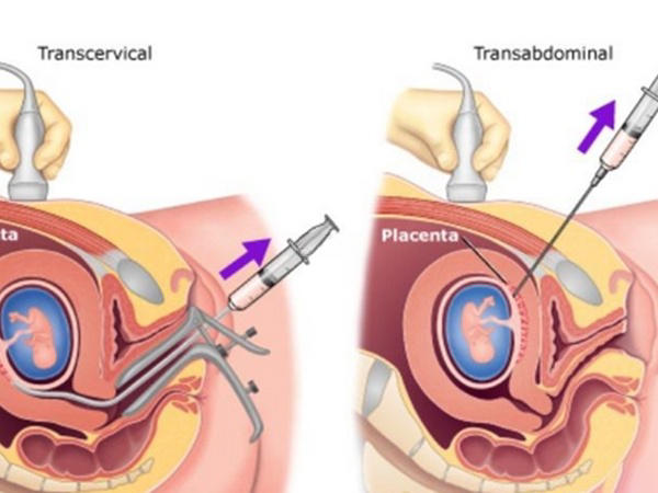 绒毛穿刺的两种操作方式