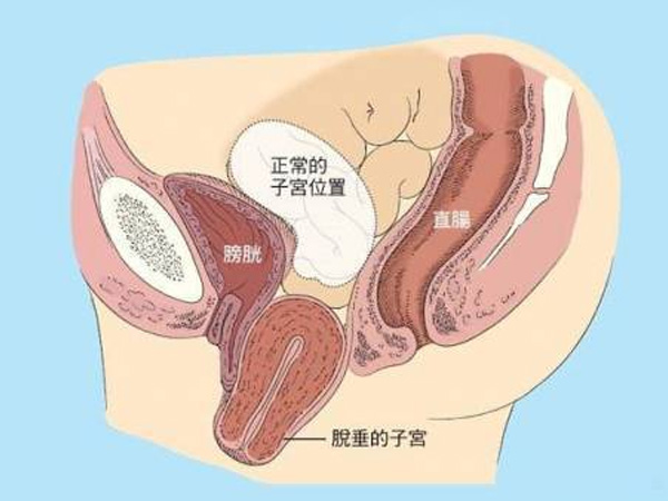 宫脱垂有三种程度