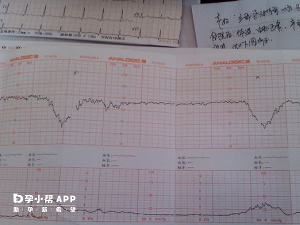 胎心监护可看胎儿在宫内的情况