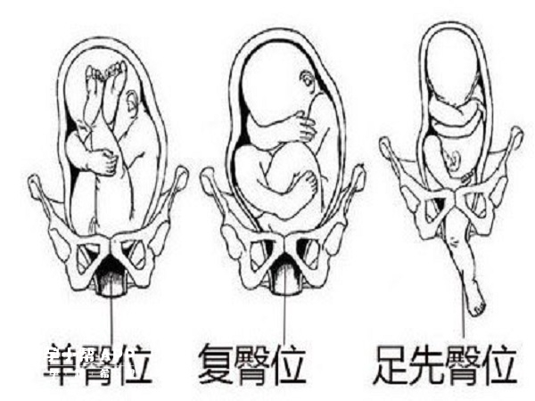 孕晚期出现臀位及时治疗