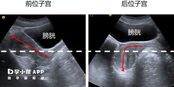 经腹部检查子宫前位和后位