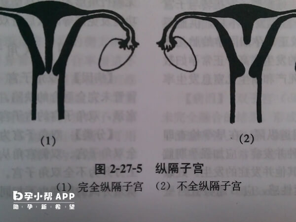 纵隔子宫分为两种