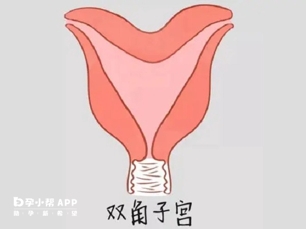 子宫畸形虽不影响试管婴儿的妊娠率但流产率及早产率高