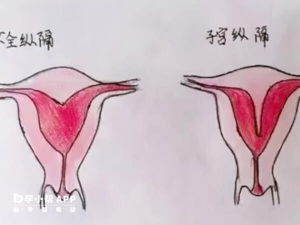 纵隔子宫怀孕三月最危险