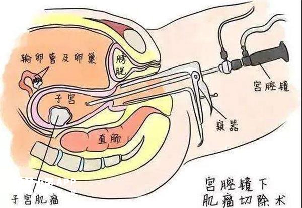 宫腔灌注示意图