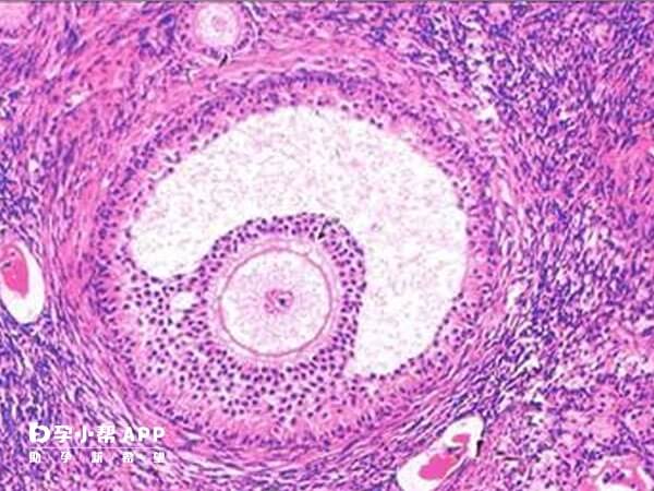 卵泡黄素化的治疗方法很多