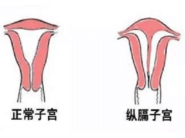 完全纵膈子宫做试管成功率有60%