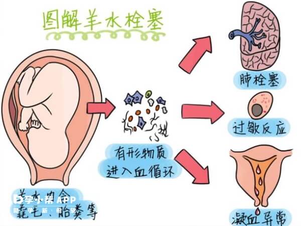 羊水栓塞图解